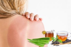 Easily-Available-Natural-Remedies-to-beat-Sunburns-300x199