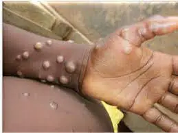 Dubai issues advisory on zoonotic disease monkeypox